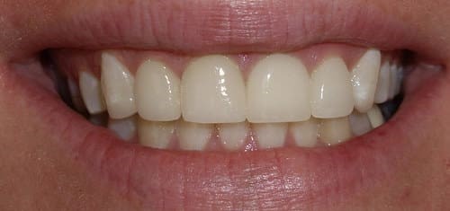 After whitening and contouring